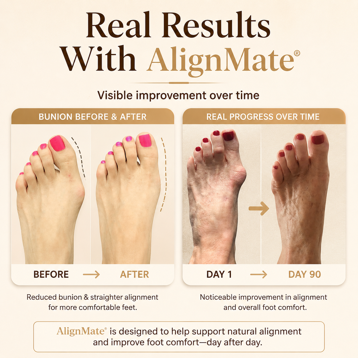 AlignMate- Fix Your Bunion Before It Gets Worse
